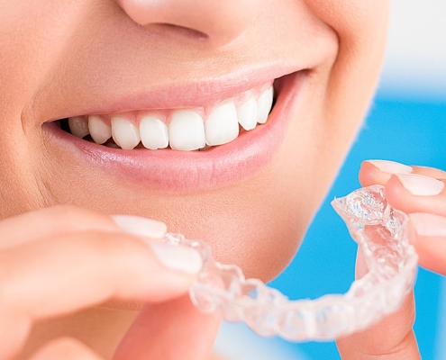 Invisalign